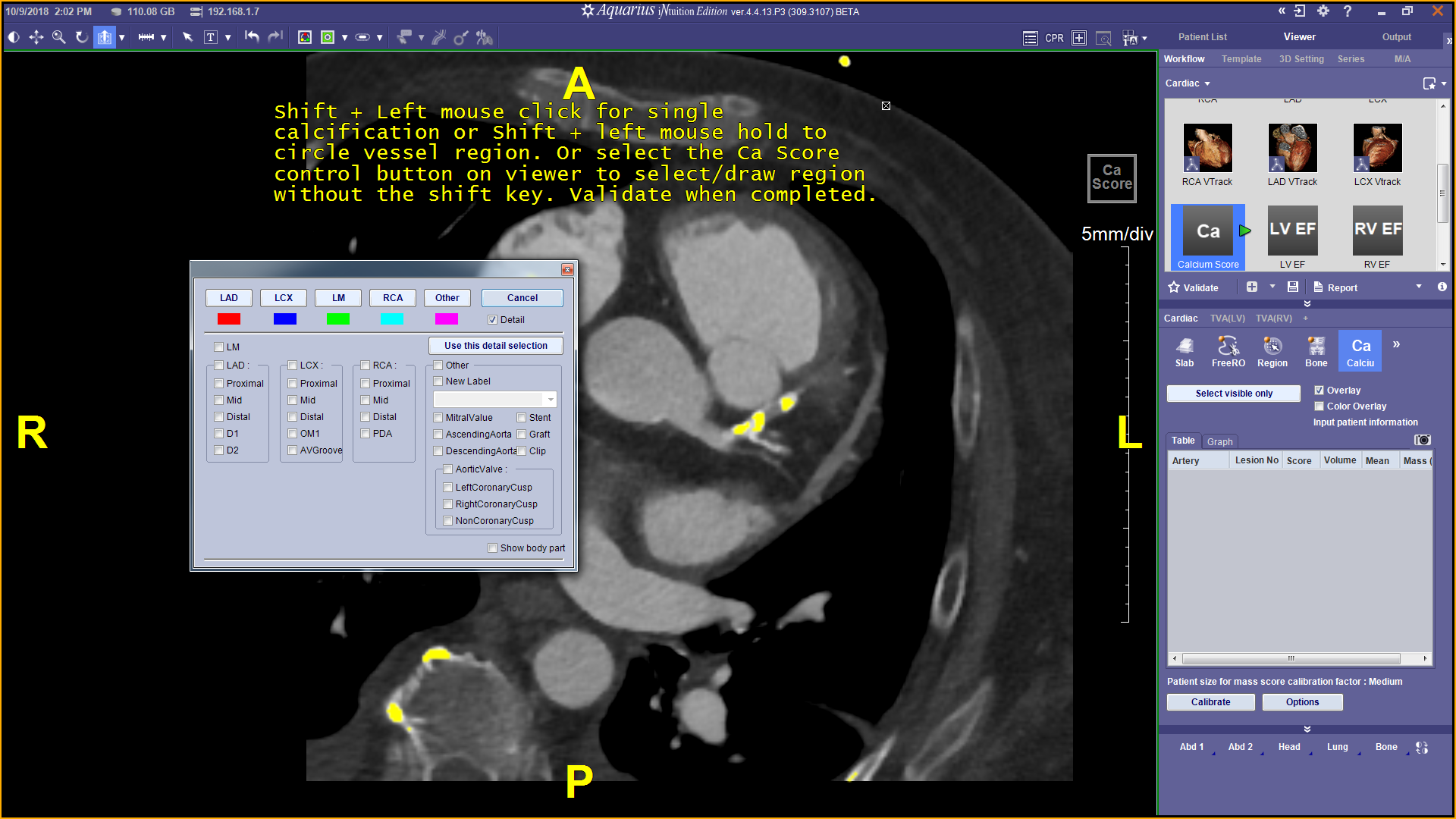 CT Cardiac Advanced Visualization Package Terarecon